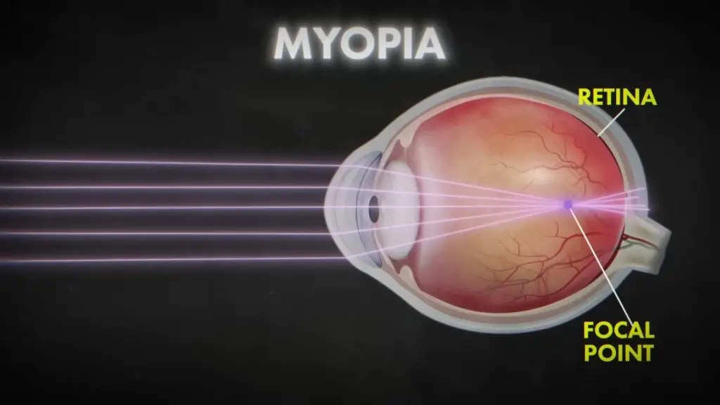 Myopia से बचाव
